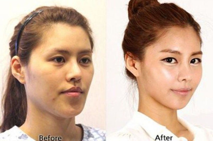 "Labios de cereza", reducción de mandíbula, fosas nasales de plástico: ¿qué operaciones son populares en Corea del Sur
