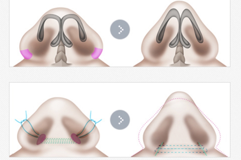 "Labios de cereza", reducción de mandíbula, fosas nasales de plástico: ¿qué operaciones son populares en Corea del Sur