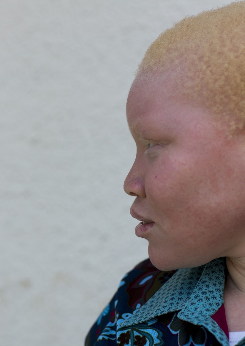 Los albinos de tanzania, cuyos cuerpos valen más que el oro
