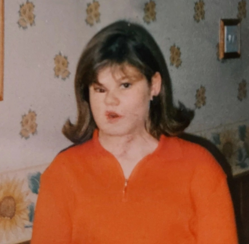 Love looks at the heart: how an Irish woman with a disfigured face found her female happiness