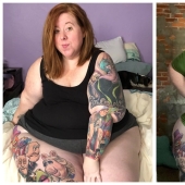 No comer en exceso, sino una enfermedad: una mujer estadounidense está luchando con lipedema con la ayuda de operaciones