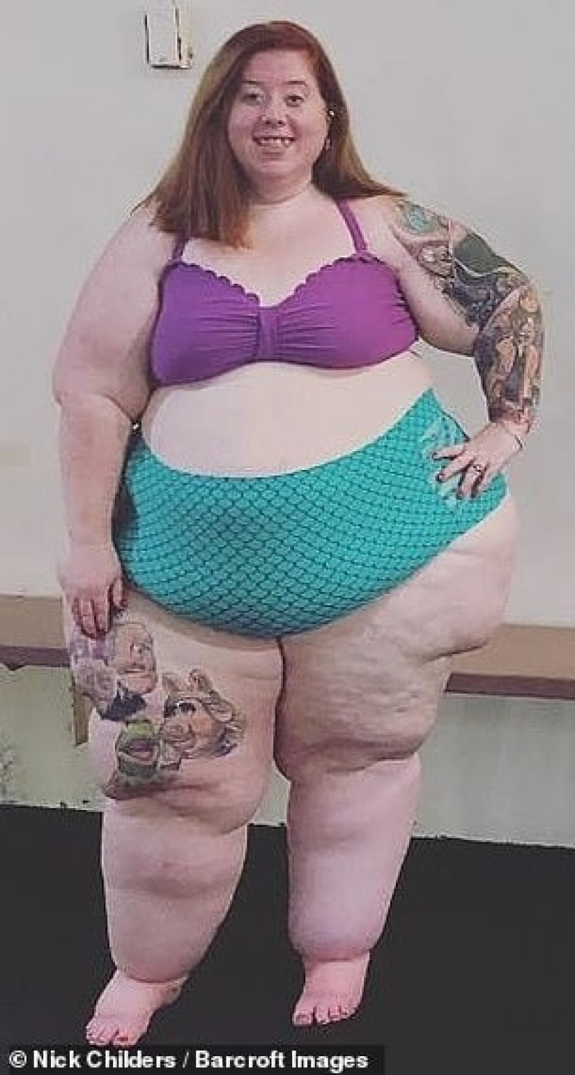 Not overeating, but a disease: an American woman is struggling with lipedema with the help of operations