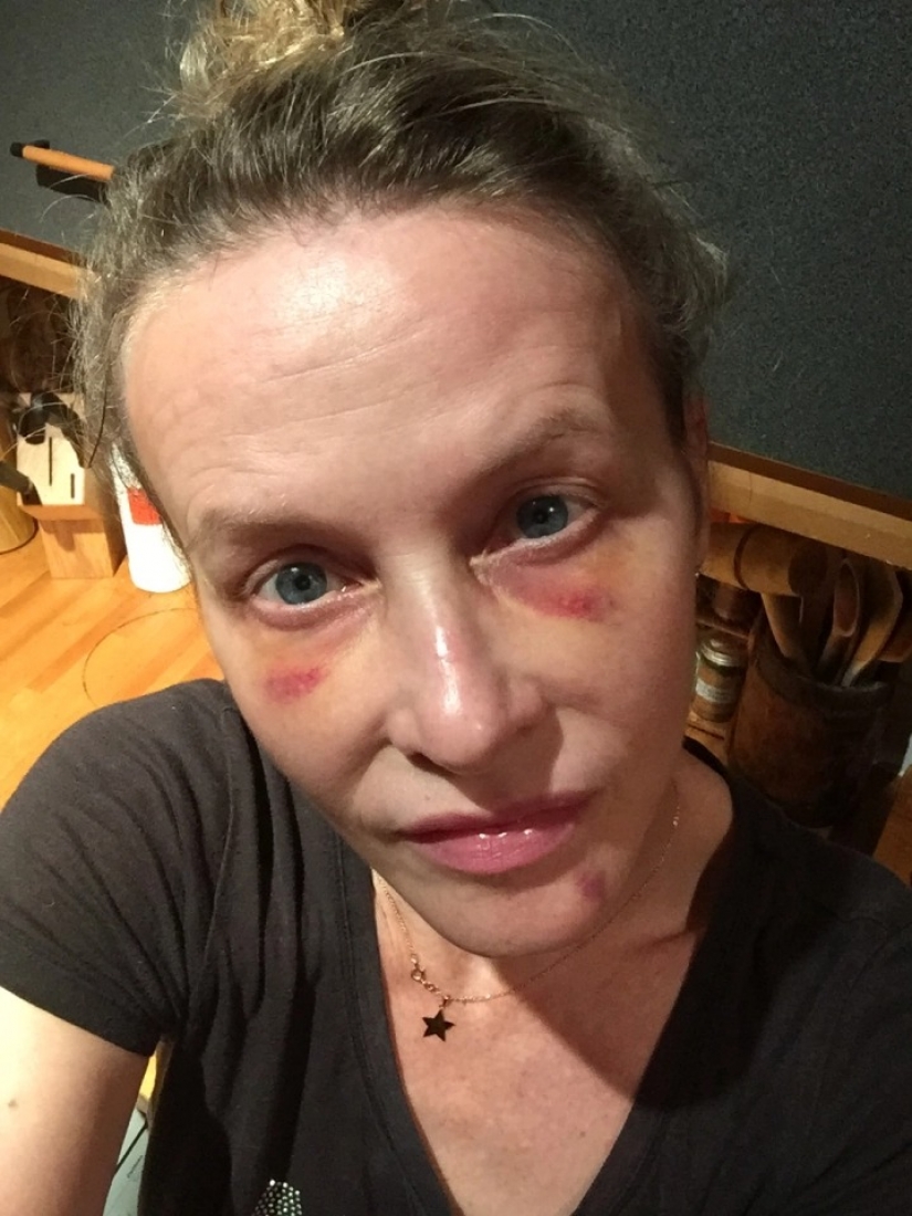 On her own skin: the British woman experienced the effects of fashionable cosmetic procedures