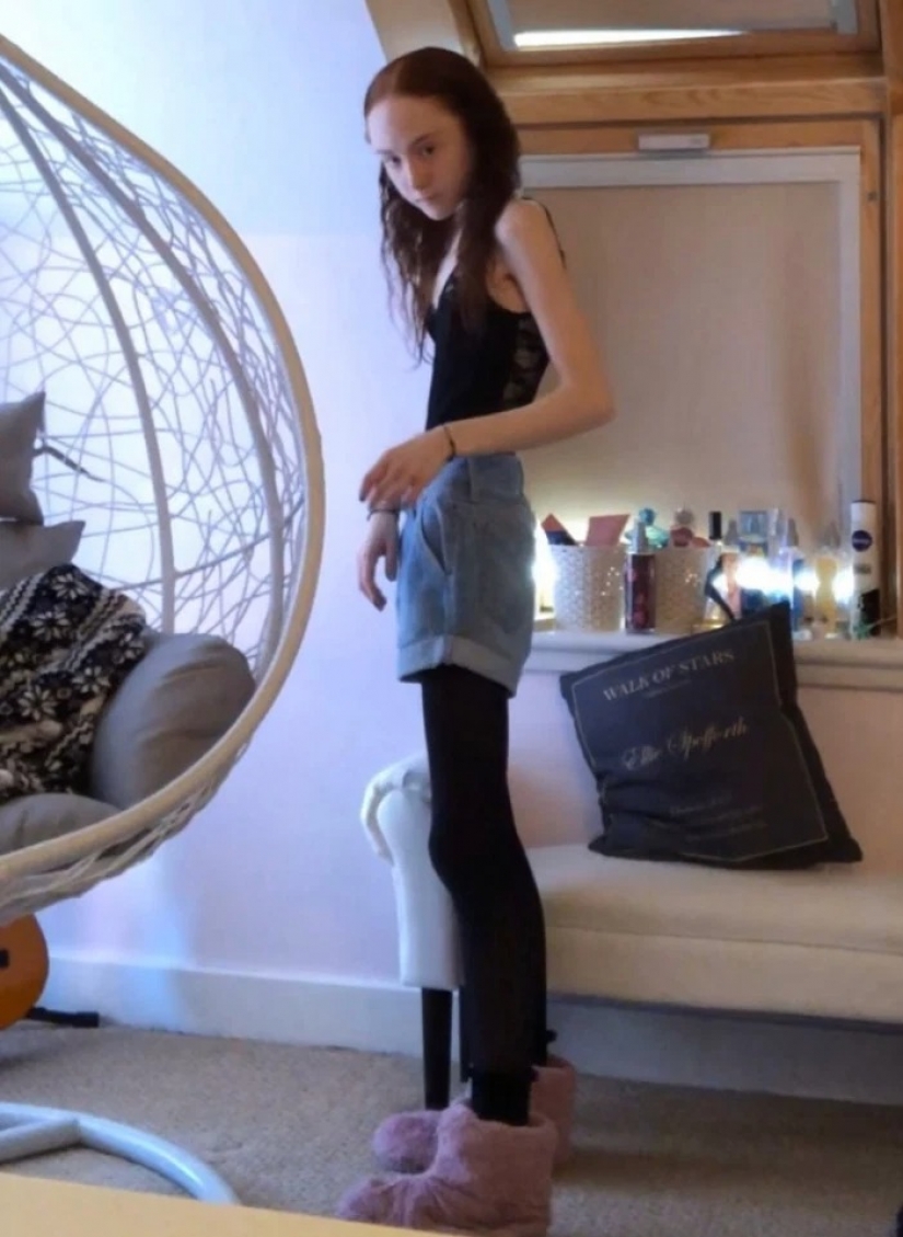 On the edge of the abyss: how a young Scottish woman weighing 25 kg was able to overcome anorexia