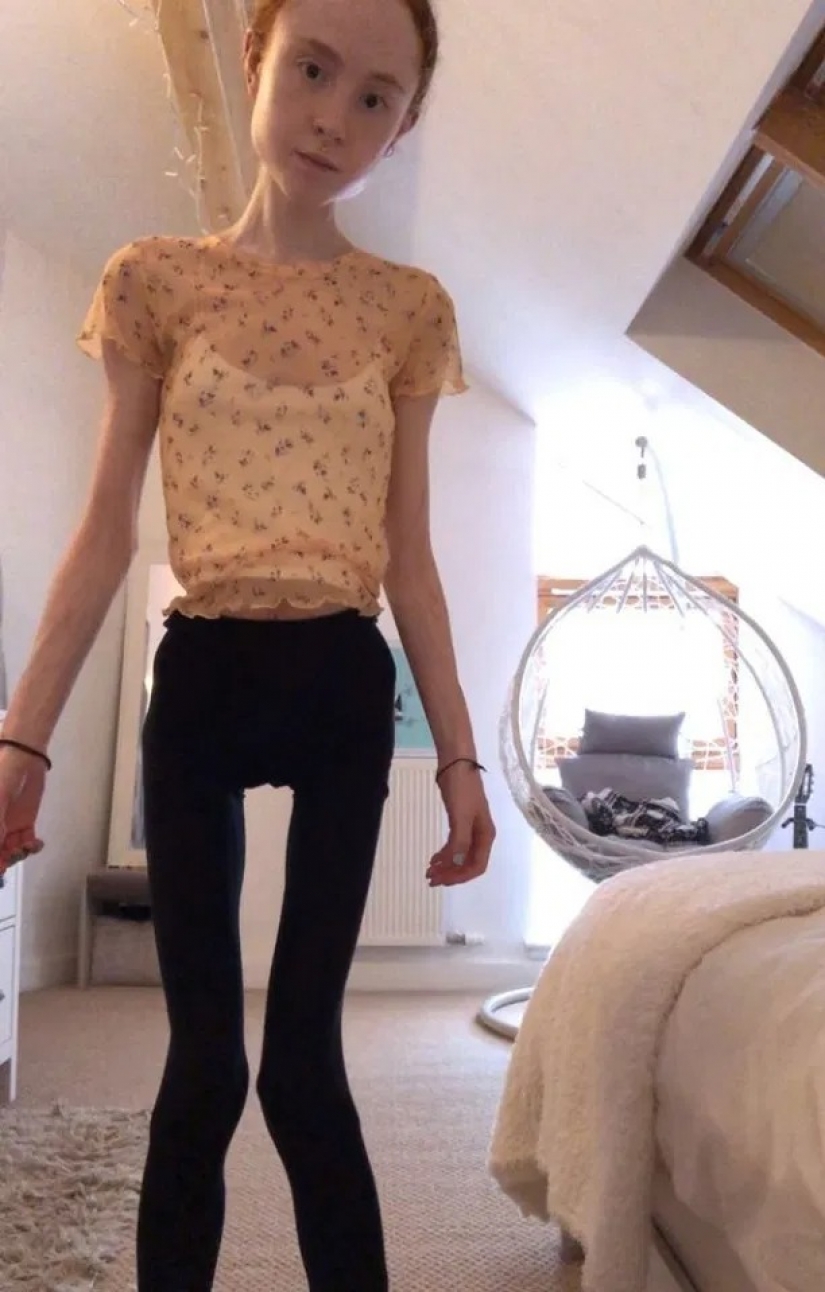 On the edge of the abyss: how a young Scottish woman weighing 25 kg was able to overcome anorexia