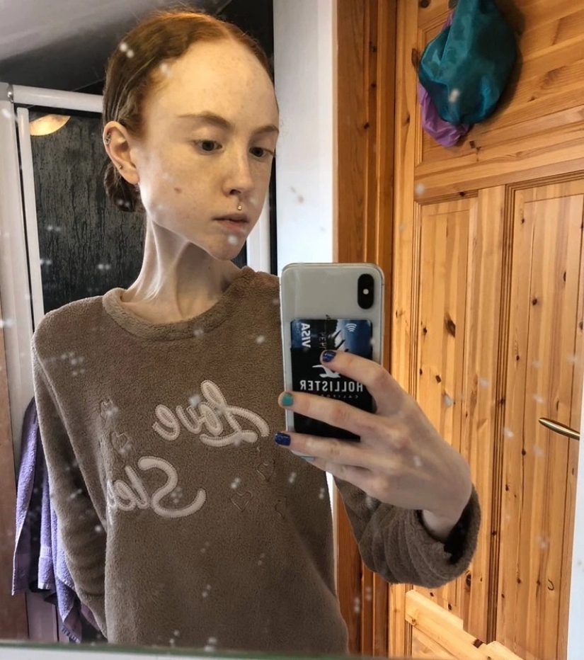 On the edge of the abyss: how a young Scottish woman weighing 25 kg was able to overcome anorexia