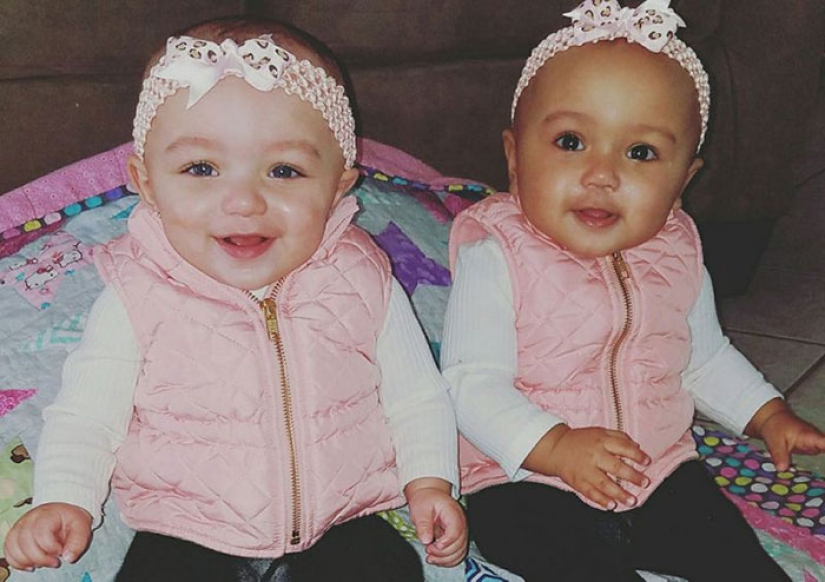 One is white, the other is tanned: a rare case of twins being born with different skin colors