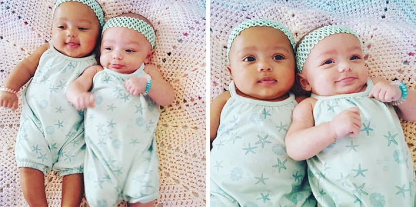 One is white, the other is tanned: a rare case of twins being born with different skin colors