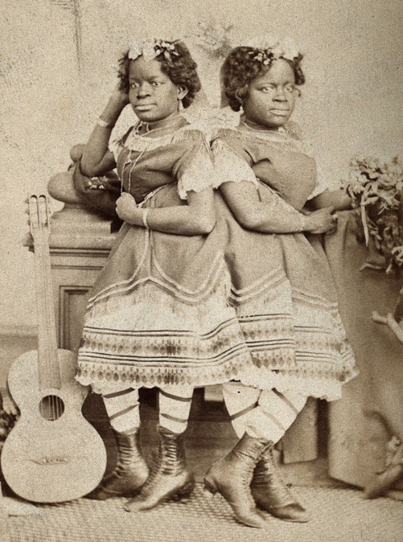 One life for two people without strain and tragedies: a happy Siamese twins