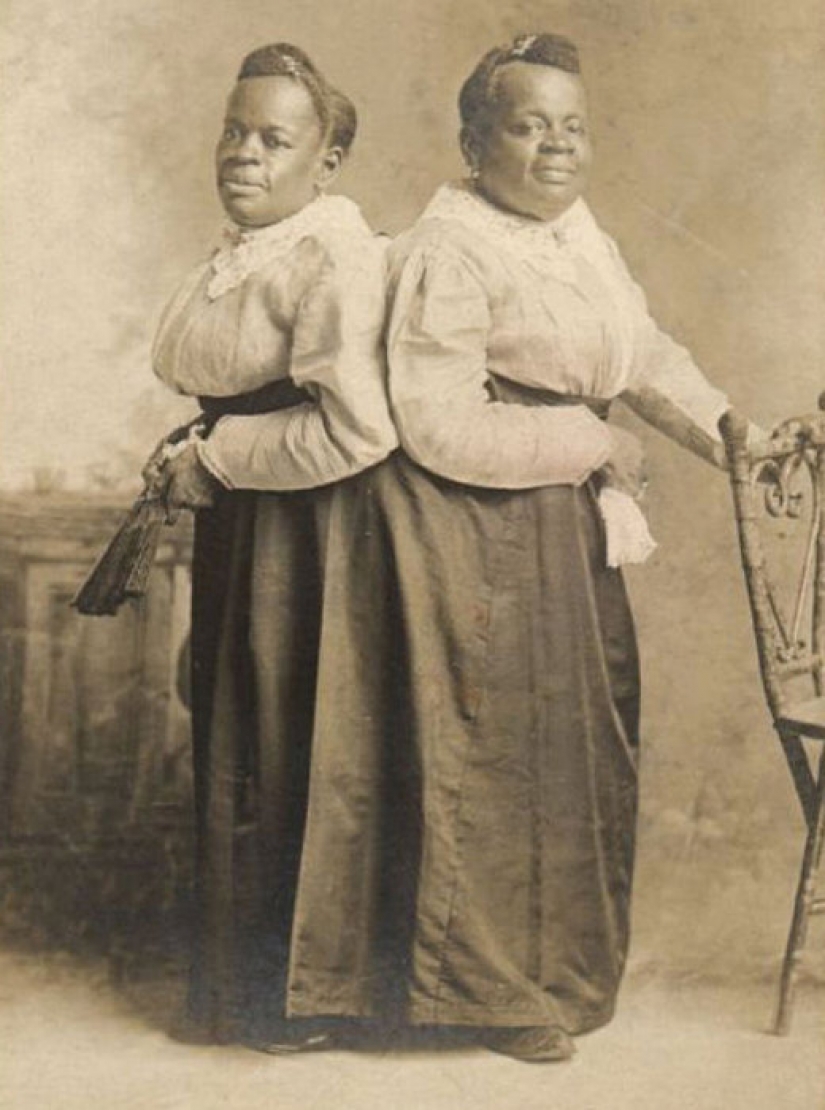 One life for two people without strain and tragedies: a happy Siamese twins