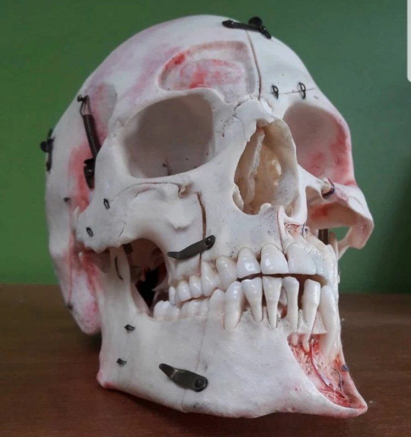 Recuento de hueso? En el mercado negro Instagram aparecido restos humanos Recuento de hueso? En el mercado negro Instagram aparecido restos humanos