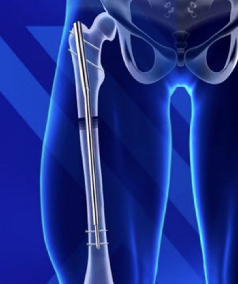 Rise above 15 cm? Easy! How does a new surgical technique is painless to increase growth