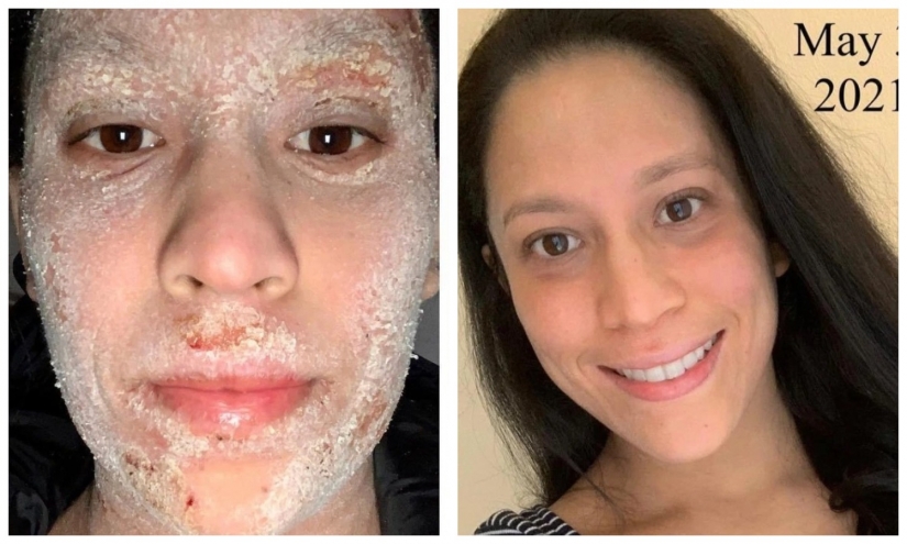 Side effect: an American woman has endured terrible suffering because of steroids to treat eczema