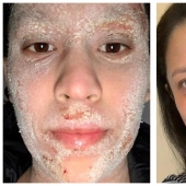 Side effect: an American woman has endured terrible suffering because of steroids to treat eczema