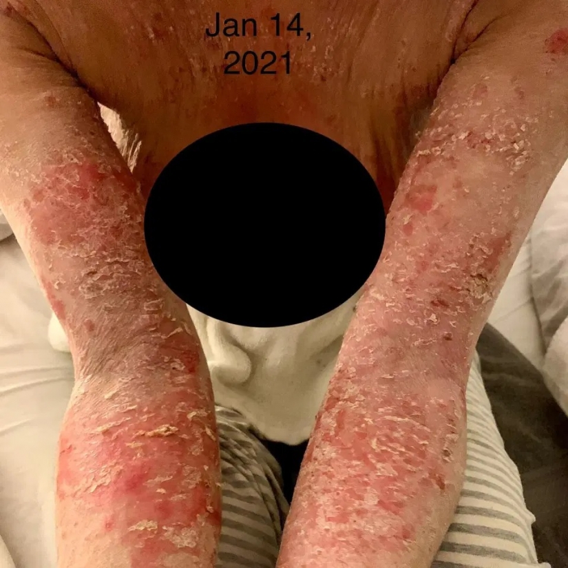 Side effect: an American woman has endured terrible suffering because of steroids to treat eczema