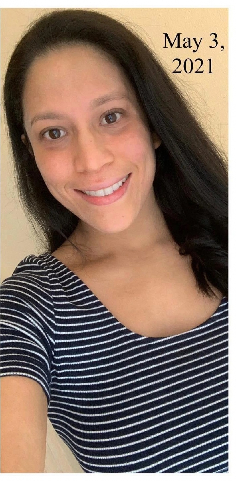 Side effect: an American woman has endured terrible suffering because of steroids to treat eczema