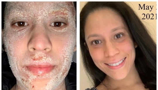 Side effect: an American woman has endured terrible suffering because of steroids to treat eczema