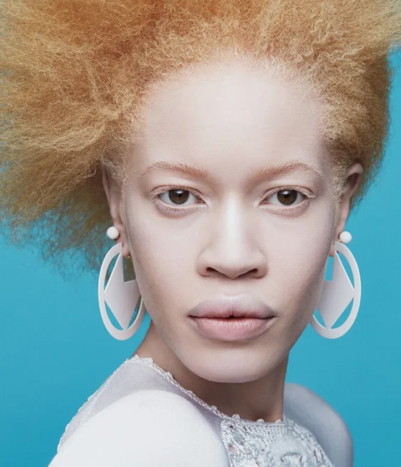 Strabismus, albinism, age: 5 models who tear the beauty template