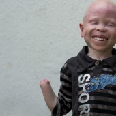 Tanzanian albinos, whose bodies are worth more than gold