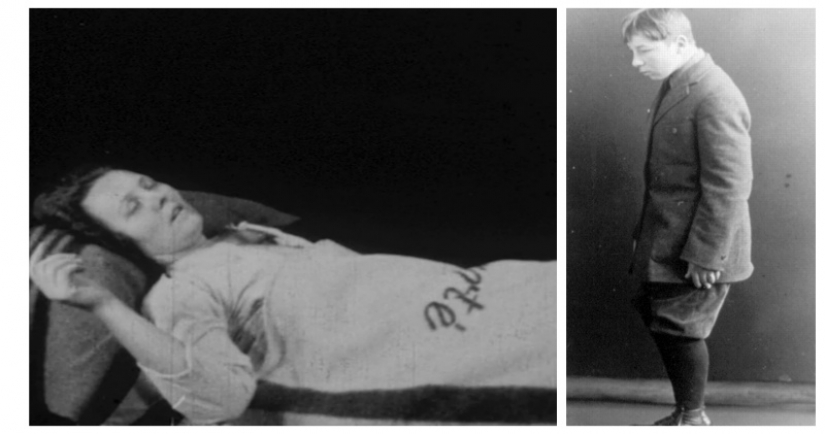 The Sleeping Sickness Epidemic: a strange disease that turned people into living zombies