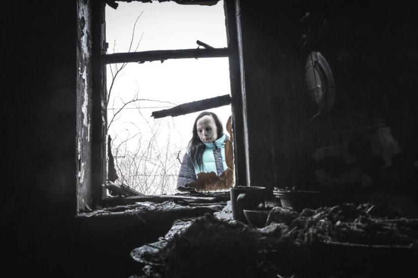 The story of Ani boldyrevoy, which has lost face because of the fire, but hopes for a better life The story of Ani boldyrevoy, which has lost face because of the fire, but hopes for a better life
