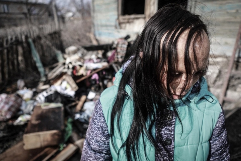 The story of Ani boldyrevoy, which has lost face because of the fire, but hopes for a better life The story of Ani boldyrevoy, which has lost face because of the fire, but hopes for a better life