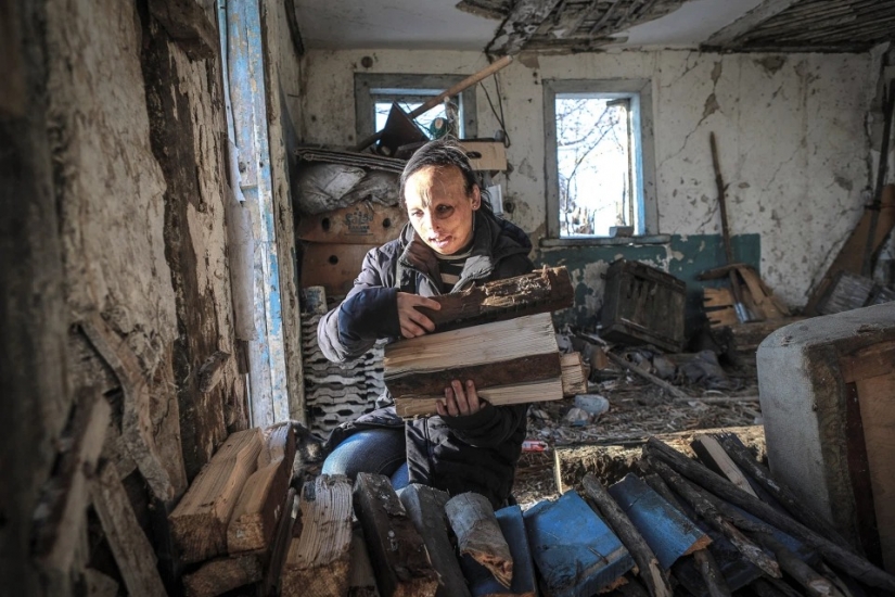 The story of Ani boldyrevoy, which has lost face because of the fire, but hopes for a better life The story of Ani boldyrevoy, which has lost face because of the fire, but hopes for a better life