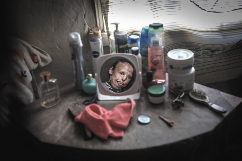 The story of Ani boldyrevoy, which has lost face because of the fire, but hopes for a better life The story of Ani boldyrevoy, which has lost face because of the fire, but hopes for a better life