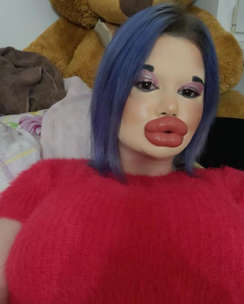 The woman with the biggest lips in the world is going to enlarge her cheeks