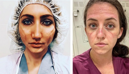 "These wounds will not go away — they will remain inside us": photos of medical girls with traces of masks on their faces