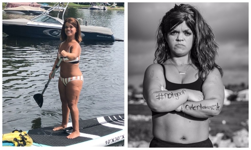 Through pain - to a dream: an American dwarf underwent complex operations for many years to grow up Through pain - to a dream: an American dwarf underwent complex operations for many years to grow up