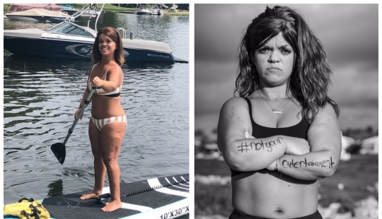 Through pain - to a dream: an American dwarf underwent complex operations for many years to grow up