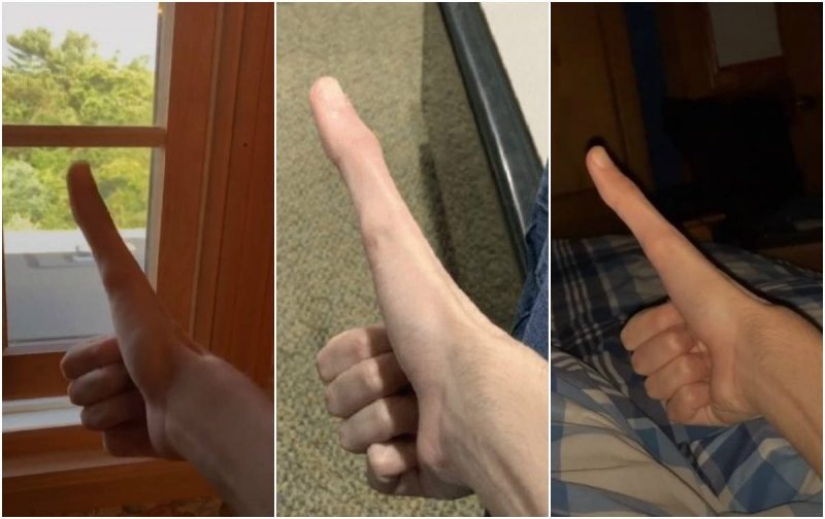 Un estudiante de los EE.UU. se convirtió en una estrella de la red social debido a una parte del cuerpo anormalmente grande