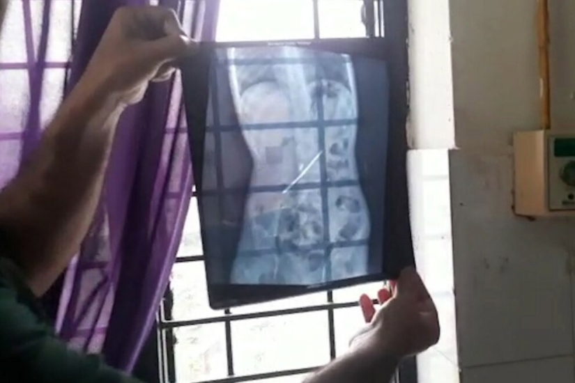 Un joven indio comía cepillos de dientes y uñas para curar la adicción