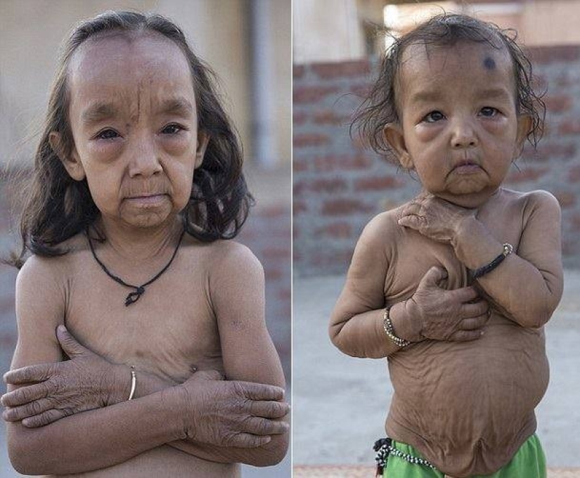 Why do brother and sister from India look like little old men Why do brother and sister from India look like little old men