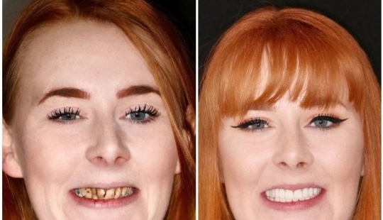 With a smile for life: how a girl transformed with terrible teeth