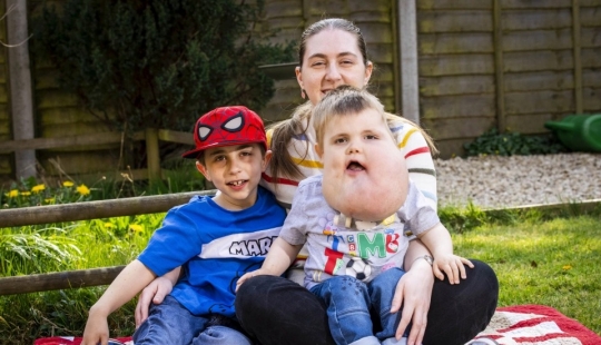 With faith in the best: a 4-year-old boy with a tumor on his face does not lose heart, despite the disease