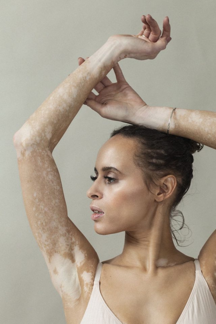 10 beautiful women with vitiligo, photographed by a photographer with the same condition 10 beautiful women with vitiligo, photographed by a photographer with the same condition
