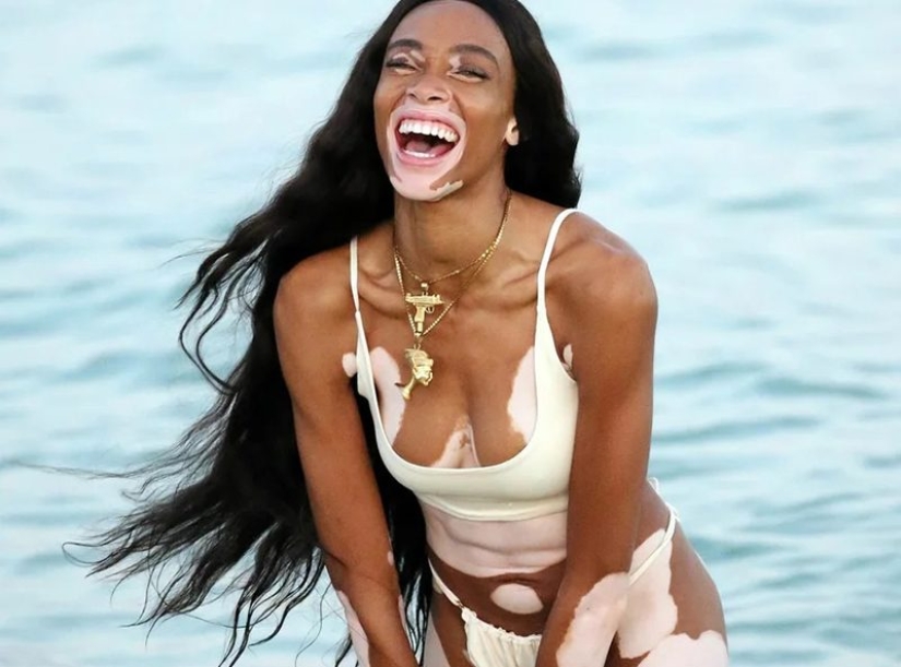 10 Girls Who Turned Their Flaws Into Strengths