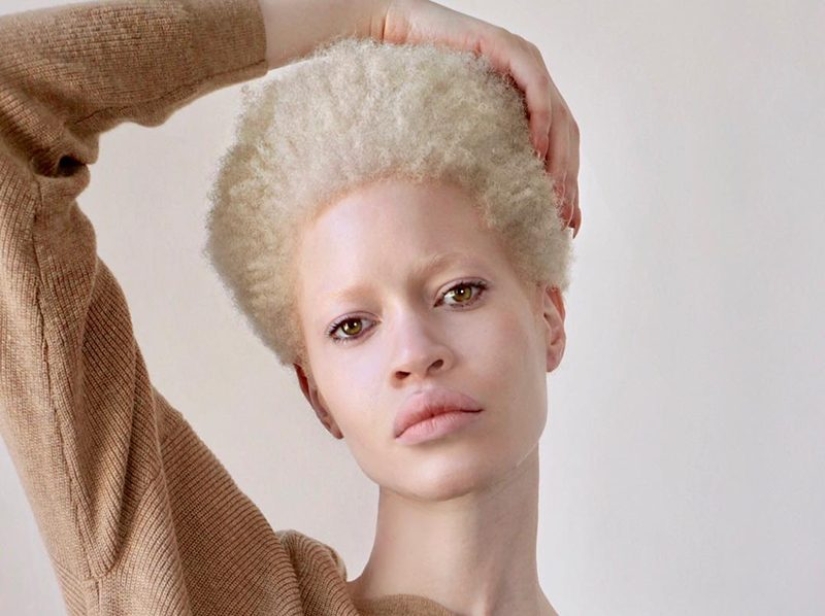 10 Girls Who Turned Their Flaws Into Strengths