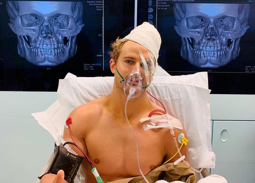 A 29-second battle: eight fractures and a skull like a hundred-year-old mummy A 29-second battle: eight fractures and a skull like a hundred-year-old mummy