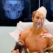 A 29-second battle: eight fractures and a skull like a hundred-year-old mummy