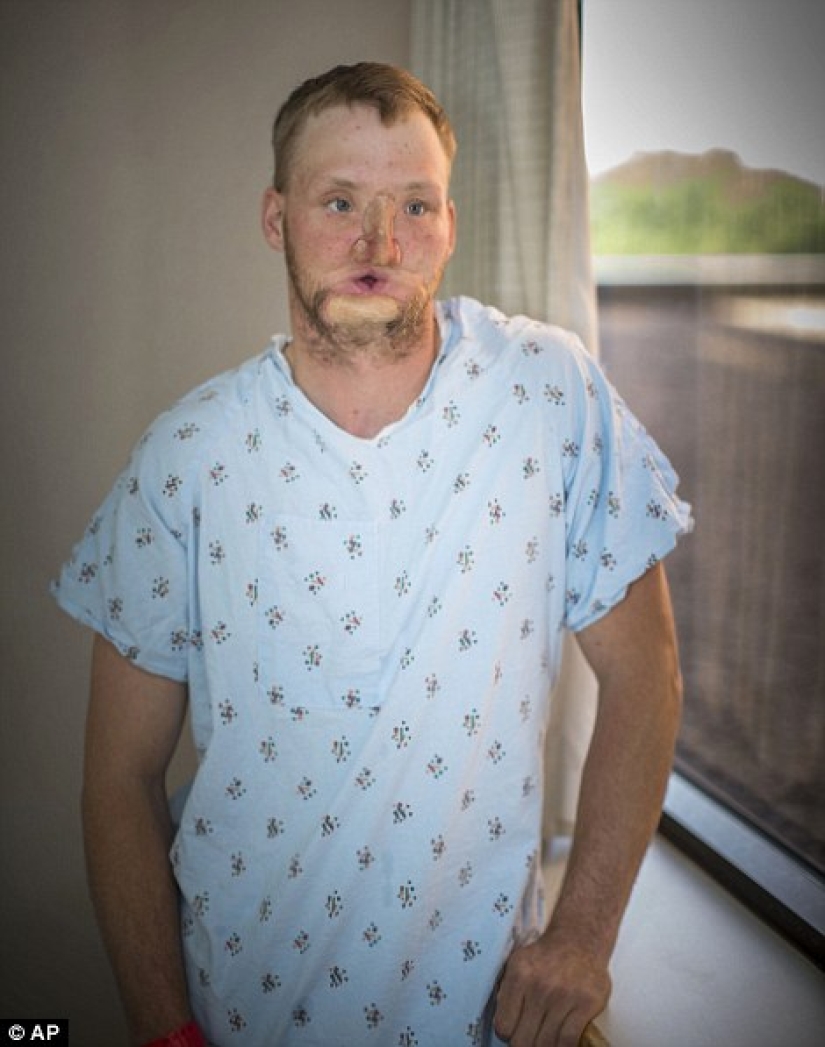 A failed suicide had his face transplanted, and a new life began for him