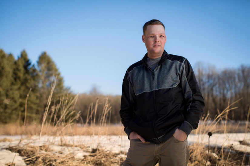 A failed suicide had his face transplanted, and a new life began for him