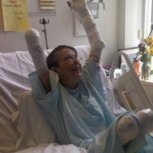 A game with a sad ending: a woman fell ill with sepsis and underwent three amputations after being bitten by her beloved dog