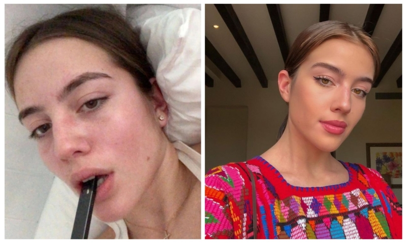 A young American woman almost became disabled due to vaping