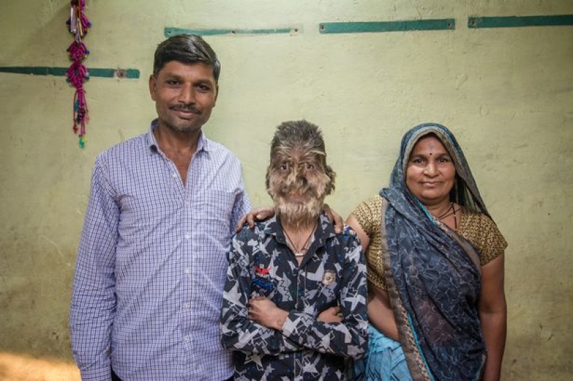 Amable y esponjoso: Un niño de 13 años de la India sufre del "síndrome del hombre lobo"