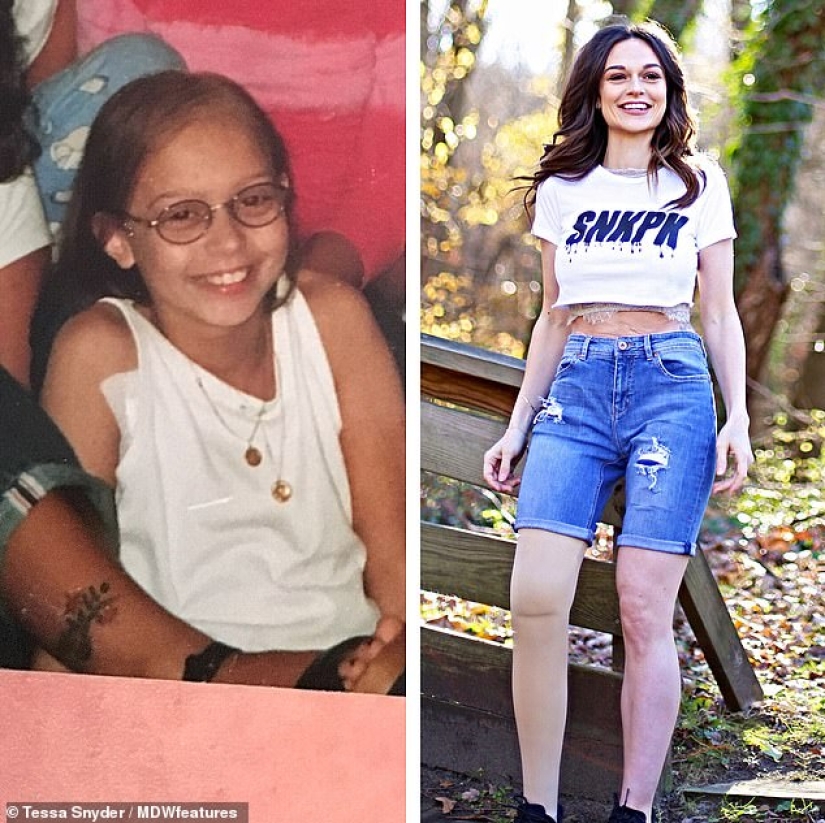 "Amputation is better already": a girl lost her leg at the age of 11, became a model and now inspires others