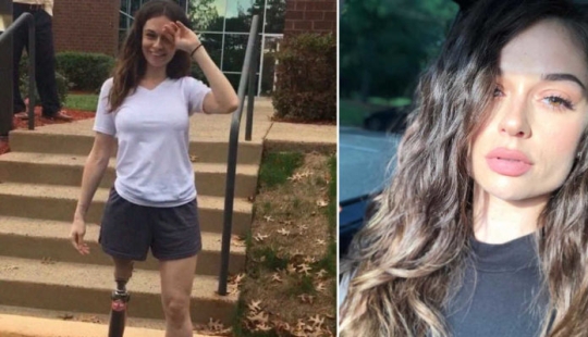 "Amputation is better already": a girl lost her leg at the age of 11, became a model and now inspires others