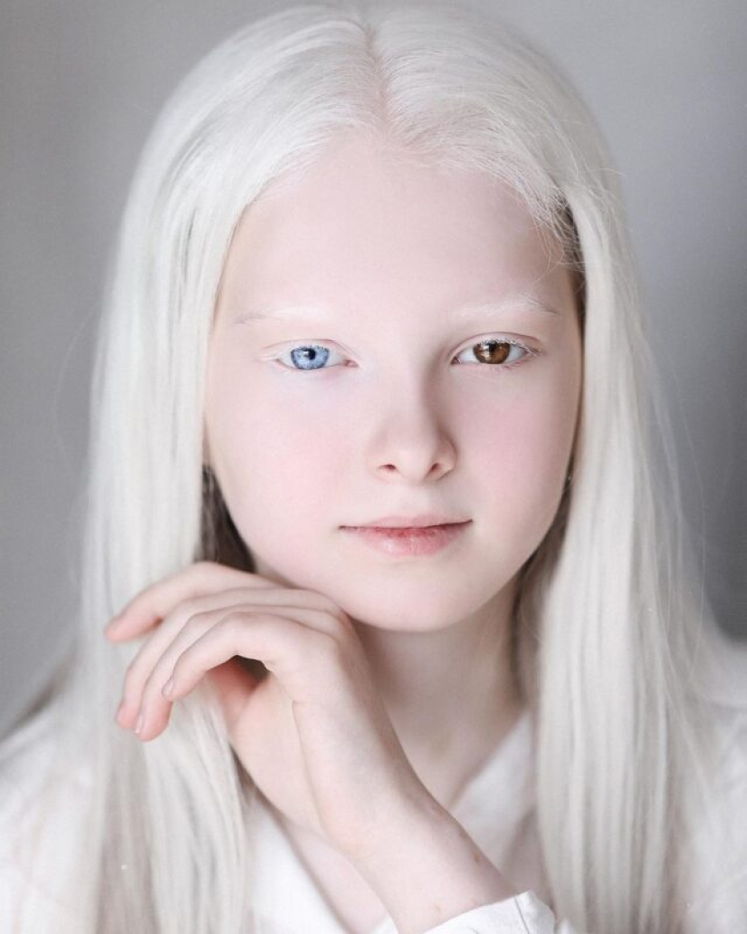 An albino girl from Chechnya struck with her unique appearance An albino girl from Chechnya struck with her unique appearance